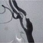 Στένωση Καρωτίδων