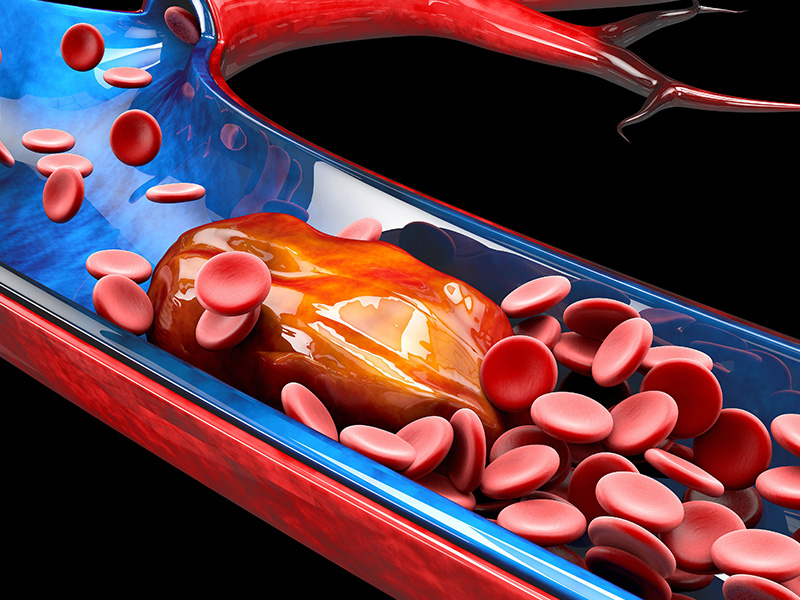 Θρομβοεμβολική νόσος